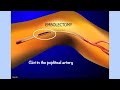 Emergent Embolectomy with removal of large amounts of clot with animation