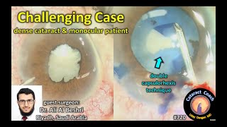 challenging cataract case: dense white cataract in a monocular patient