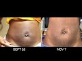 Stomach Chemical Peel (Post Baby) Full Process  Procedure  Peeling  Before & After