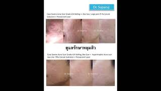 ตัวอย่างผลการดูแลรักษาแผลเป็นหลุมสิว ด้วยเทคนิค Multimodality Acne Scar Treatment  หมอรุจชวนคุย