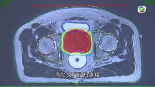 香港新聞 癌症病人電療 有醫院引入新式治療機 更準確找出腫癌位置 可減少電療次數-醫療系列 - TVB News