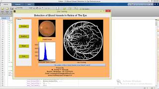 Blood Vessels Detection in Retina of the Eye Matlab Project with Source Code