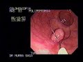 colonoscopy of a polypectomy of a rectal polyp