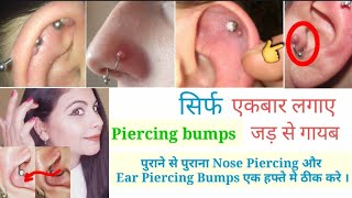 सालो पुराना Ear Piercing और Nose Piercing bump एक हफ्ते मे ठीक करे/ Home remedies for Piercing Bump