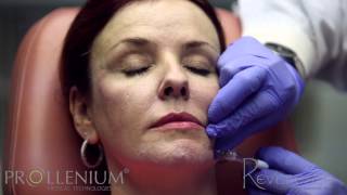 Revanesse Contour- Chin, Cheeks, Temples and Nasolabial Folds