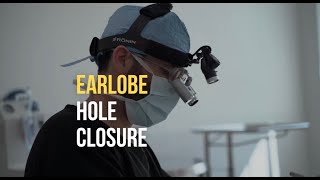 Earlobe Hole Closure