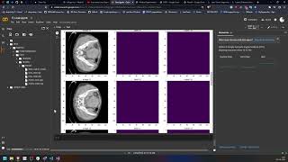 Liver segmentation using Monai