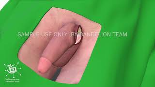 penis implant 3d medical animation | sample use only  by Dandelion Team
