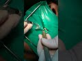 cómo se realiza un tratamiento de conducto o endodoncia paso a paso