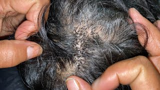 #nitspicking wife removed husband lices from long hairs //husband and wife,lice removal👀🧑🏾‍🦱🇮🇳