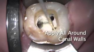 GuttaCore® Sealer Placement with Dr. David Landwehr | Dentsply Sirona