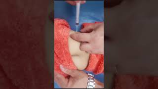 ابرتين حقنة عضل intramusclar injection