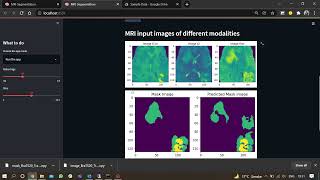 Brain Tumor Segmentation || V Net || Computer Vision || Streamlit App