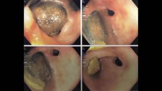 Diverticulitis: Laparoscopic Assisted Transanal Minimally Invasive Repair of Colorectal Anastomosis