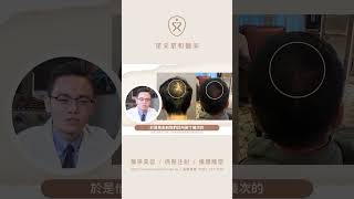 【案例分享-生髮】如果我有雄性禿的問題也可以治療嗎？ ▍星采星和醫美