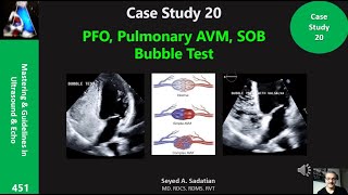 Case Study 20: PFO, Pulmonary AVM, SOB \u0026 Bubble Test