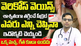 Varicose Veins | వెరికోస్ వెయిన్స్ శాశ్వతంగా తగ్గించే సీక్రెట్ | Dr Ajay B Mosur | iD Health Mantra