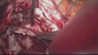 REDO tricuspid replacement on beating heart through right  minithoracotomy.