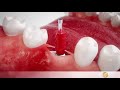 implantology your way to firmly attached dental implants full course of treatmen