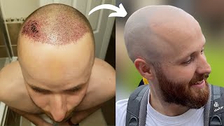 BALD After My $10,000 Hair Transplant