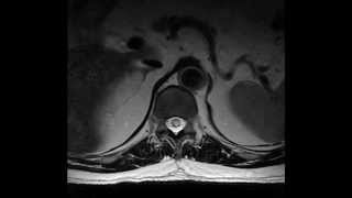 Balloon-assisted transarterial embolization of Type 1 spinal dural arteriovenous fistula