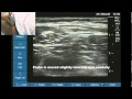 Ultrasound location of lateral femoral cutaneous nerve