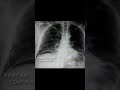 case 229 free air under diaphragm x ray