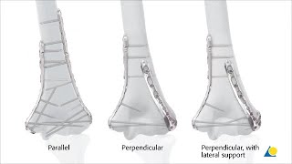 Humerus, Distal - Fracture 13C3 - Fixation with VA-LCP Distal Humerus Plates —Perpendicular Plating