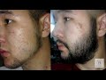 antes e depois minoxidil kirkland barba 6 meses.