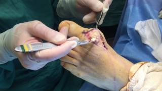 Gout Surgery Removing Gout Crystals