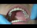 occlusal disease the silent enemy