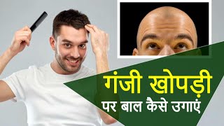 गंजी खोपड़ी पर बाल कैसे उगाएं | How Grow Hair on Bald Scalp ? | Dr Mukesh Aggarwal