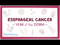 Esophageal Cancer (Year of the Zebra)