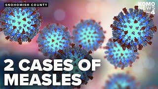 2 cases of measles exposure confirmed in Snohomish County