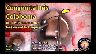 congenital iris coloboma repair with tension rod suture technique