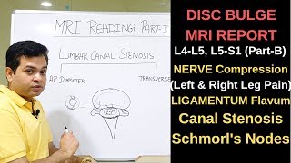 Herniated disc MRI, How to read MRI lumbar spine, Nerve compression L4-L5, L5-S1 Canal Stenosis