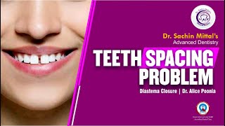 Teeth Spacing Problem | Diastema Closure | Dr. Alice Poonia