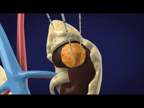 CryoAblation CryoAblation