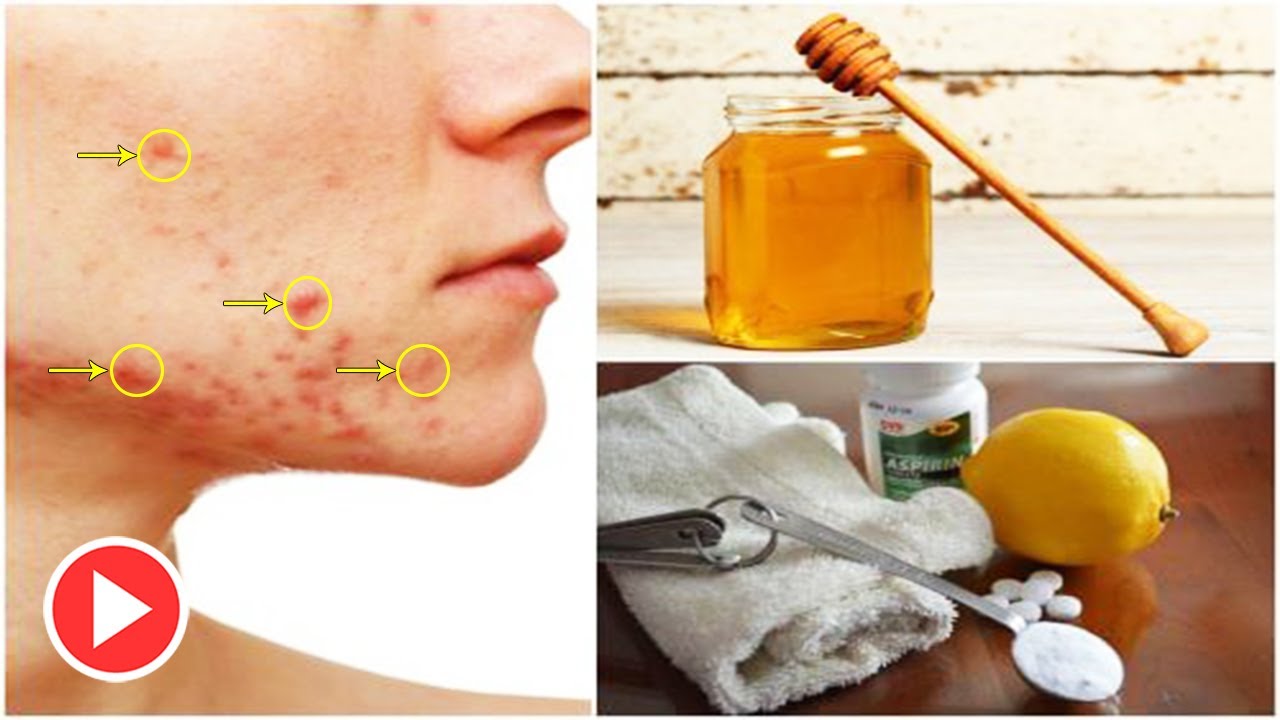 4 Acne Scars Home Remedies Mask With 100 Work Results Remove Acne