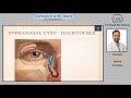 dacryology webinar part 2 recording congenital dacryocele advances