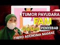 KENALI GEJALA TUMOR JINAK PAYUDARA FIBROADENOMA MAMAE - FAM - Tumor payudara yg di alami Marshanda