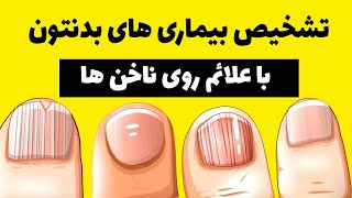 تشخیص بیماری های بدن با علائم روی ناخن !