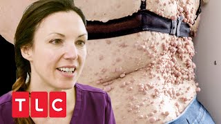 Tumore am ganzen Körper | Dr. Emma: Hautärztin aus Leidenschaft | TLC Deutschland