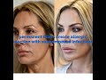 deconstructing facelift by dr. renato calabria