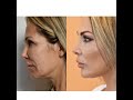 deconstructing facelift by dr. renato calabria