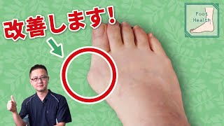 How to walk improves hallux valgus and many foot diseases!