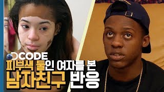 (감동주의) 남자친구에게 피부병을 고백했습니다 [DCODE]