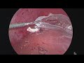 robotic low anterior resection with liver wedge metastasectomy