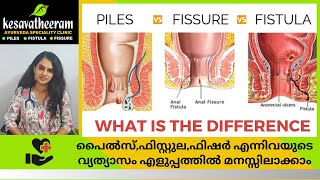 പൈൽസ്,ഫിസ്റ്റുല,ഫിഷർ - വ്യത്യാസം എളുപ്പത്തിൽ മനസ്സിലാക്കാം - Difference b/w Piles, Fistula \u0026 Fissure