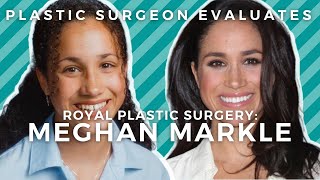 Royal Plastic Surgery: Meghan Markle's Nose Job, Breast Implants, and Veneers?